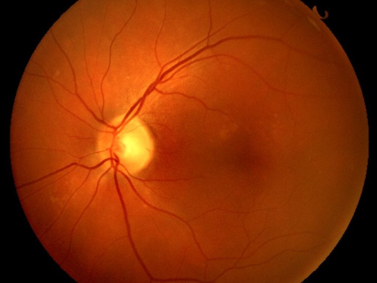 SehVia Service – Netzhautscan beim Hausbesuch Netzhautanalyse und Netzhautscan – SehVia mobiler Optiker Leipzig